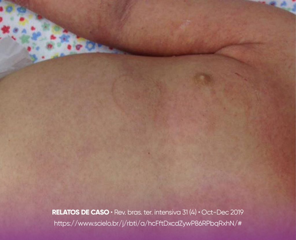 Síndrome de choque tóxico estreptocócico 2 imagem 2 blog sindrome de shock toxico